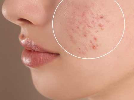 Acne Treatment | 3 Services Hot on Sale